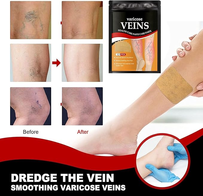 Varicose Veins Treatment Patch